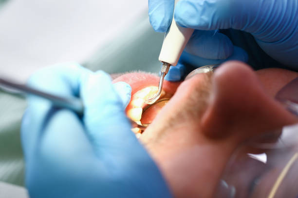 Best Emergency Dental Care for Broken or Chipped Teeth in South Zanesville, OH